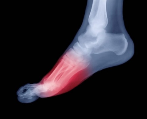 dolor plantar Farmacia Acacia en Leganés