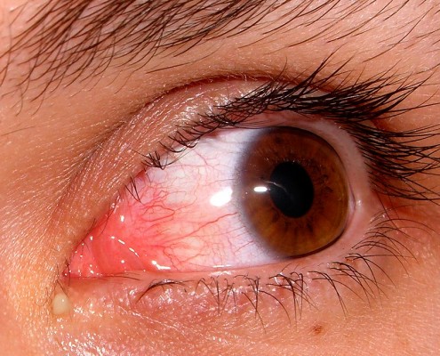 ojo_rojo Farmacia Acacia en Leganés