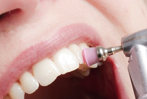 Limpieza-dental